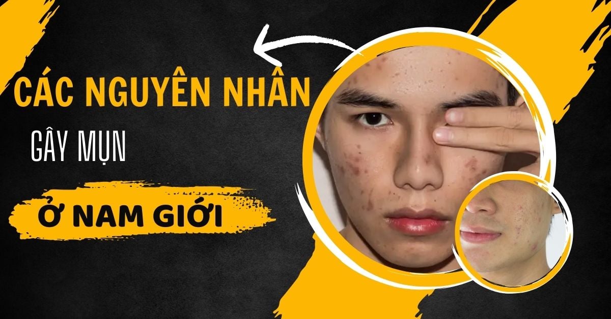 Các Nguyên Nhân Gây Mụn Ở Nam Giới Dậy Thì – Trưởng Thành