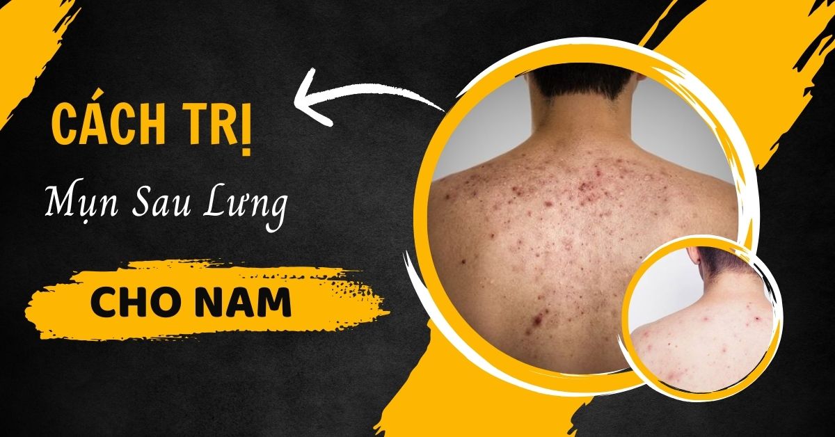 Cách Trị Mụn Sau Lưng Cho Nam Tại Nhà Với Giá 0 ĐỒNG