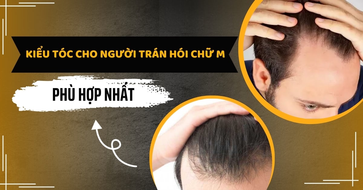 Gợi Ý Kiểu Tóc Cho Người Trán Chữ M Nam Phù Hợp Nhất
