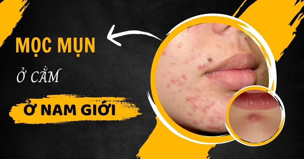 Nguyên Nhân Mọc Mụn Ở Cằm Ở Nam Giới? Cách Phòng Tránh