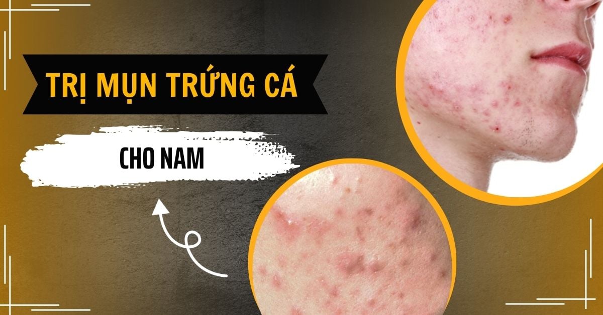 Cách Trị Mụn Trứng Cá Cho Nam Giới “Hiệu Quả” Ngay Tại Nhà