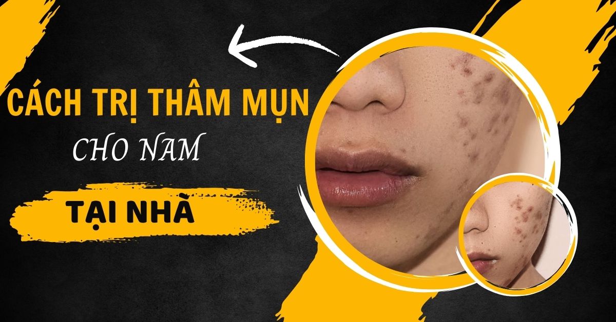 [TOP 1] Cách Trị Thâm Mụn Cho Nam Tại Nhà Hiệu Quả