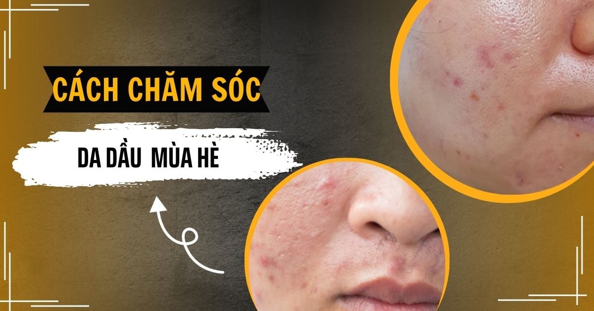 Cách Chăm Sóc Da Dầu Cho Nam Vào Mùa Hè Hiệu Quả Chỉ 6 Bước