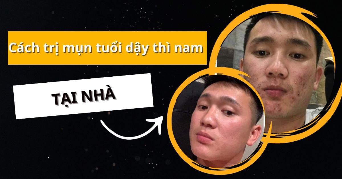 Bí Quyết Cách Trị Mụn Tuổi Dậy Thì Nam Tại Nhà: Từ A Đến Z