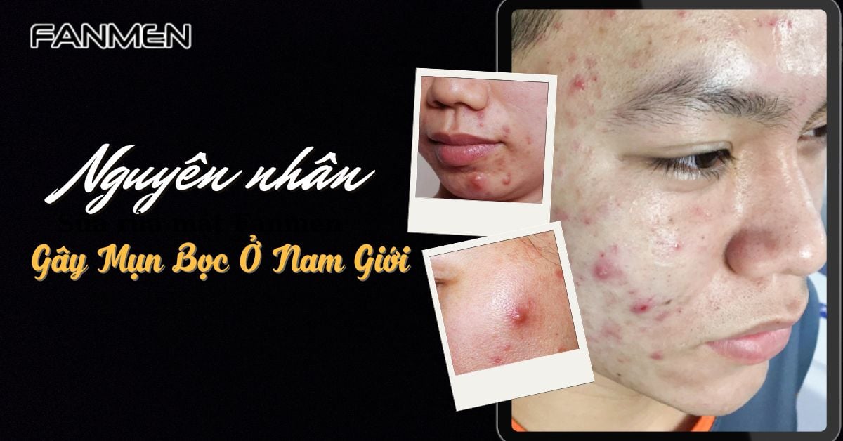 Nguyên Nhân Gây Mụn Bọc Ở Nam Giới? Cách Phòng Tránh Tại Nhà