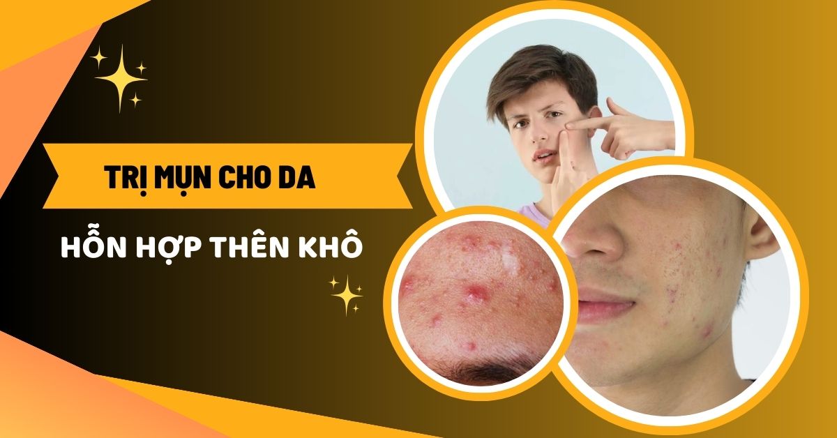 #5 Kem Trị Mụn Cho Da Hỗn Hợp Thiên Khô “Hiệu Quả Tận Gốc”