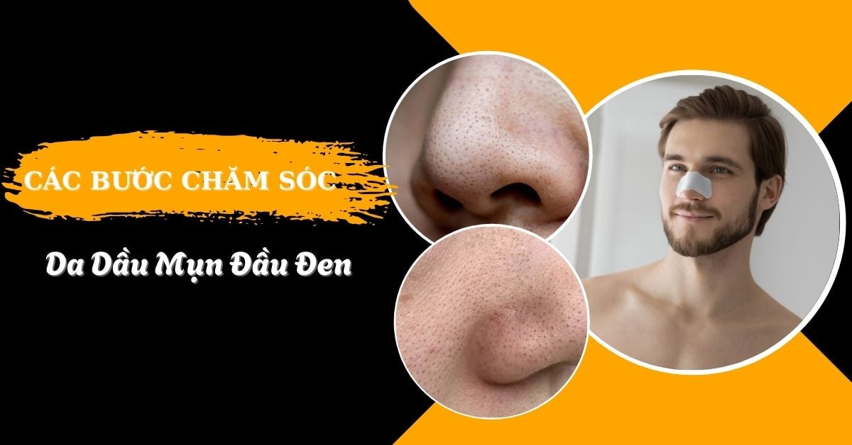 Các Bước Chăm Sóc Da Mụn Đầu Đen Hiệu Quả Chỉ Sau 7 Ngày