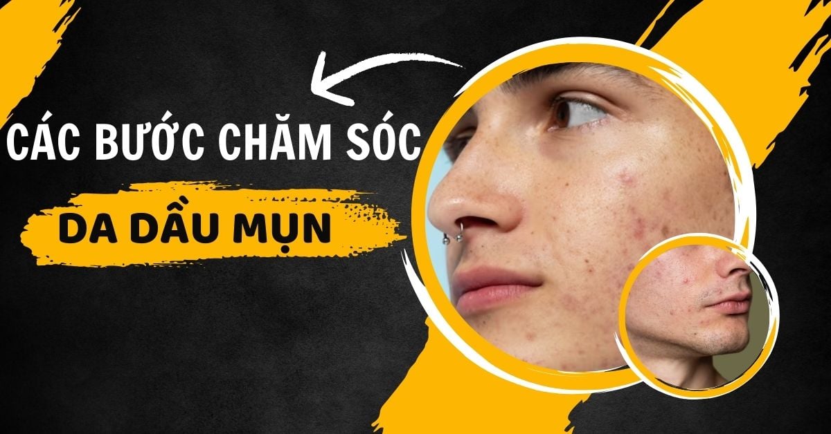 Các Bước Chăm Sóc Da Dầu Mụn Cho Nam Hiệu Quả Chuẩn Da Liễu