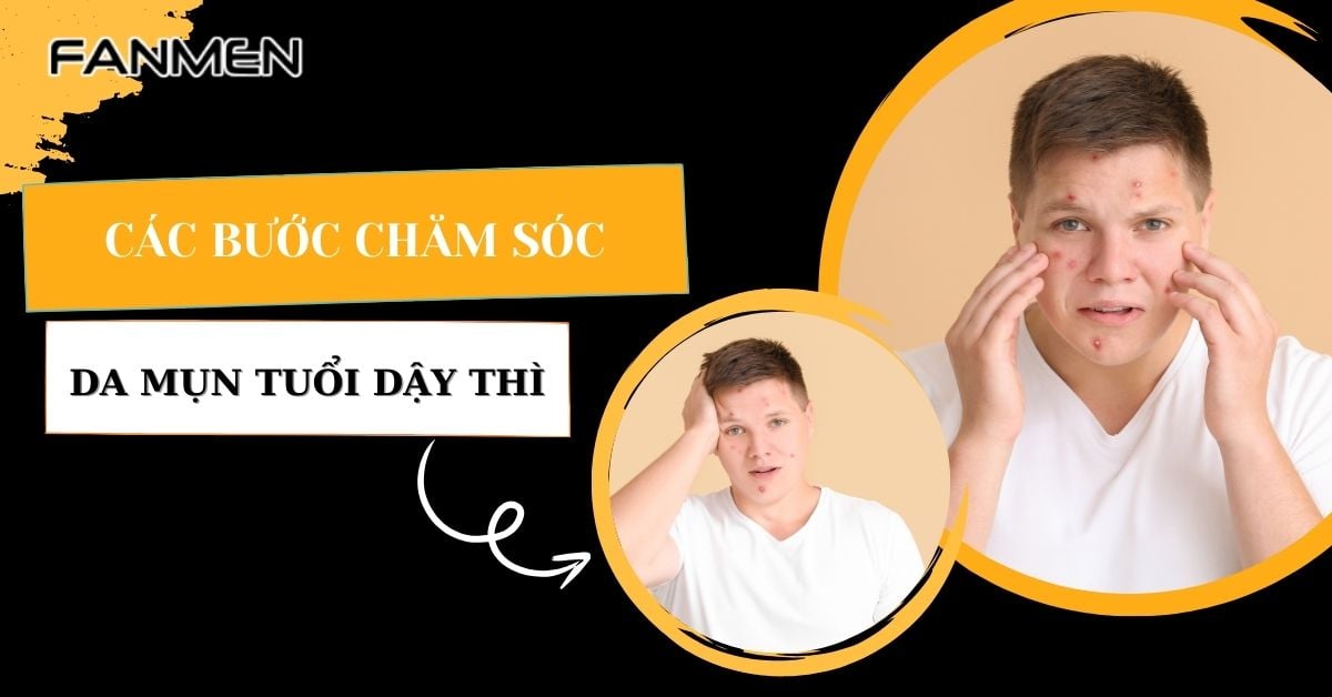 Các Bước Chăm Sóc Da Dầu Mụn Tuổi Dậy Thì Nam Từ Chuyên Gia
