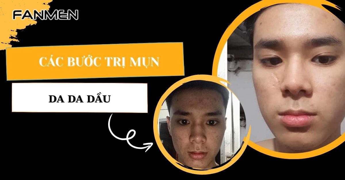 Các Bước Trị Mụn Cho Da Dầu Nam Bất Ngờ Chỉ Sau 1 Tuần