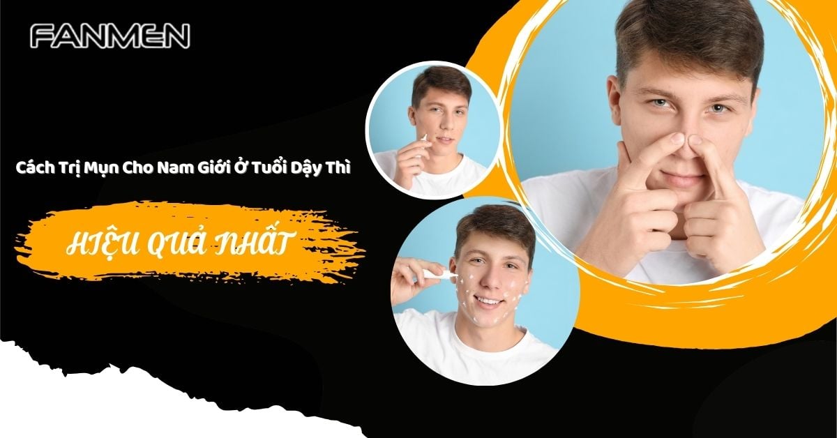 Cách Trị Mụn Cho Nam Giới Ở Tuổi Dậy Thì Đúng Và Hiệu Quả