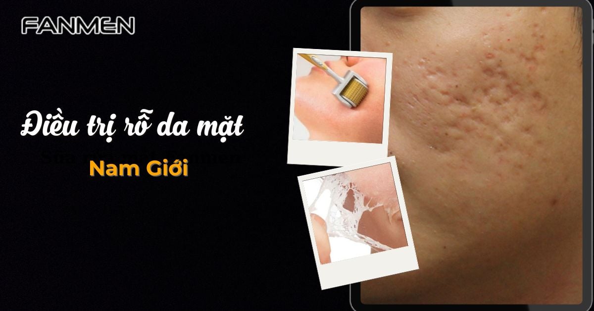 6 Cách Điều Trị Rỗ Da Mặt Nam Giới “Hiệu Quả” Nhanh Chóng