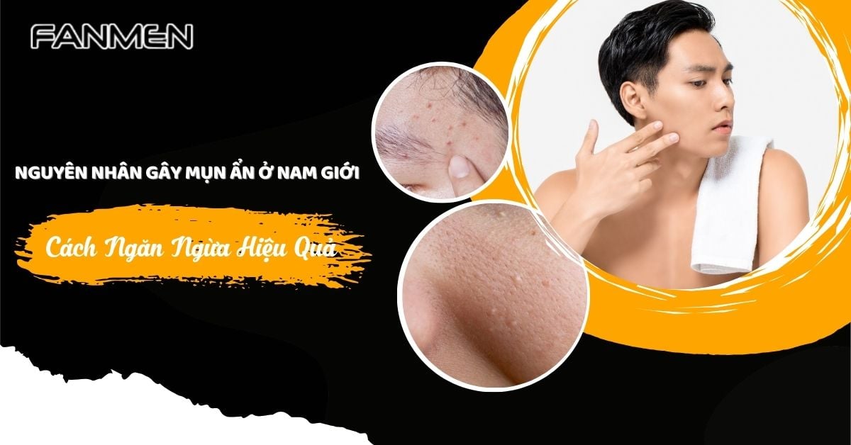Nguyên Nhân Gây Mụn Ẩn Ở Nam Giới Và Cách Ngăn Ngừa Hiệu Quả
