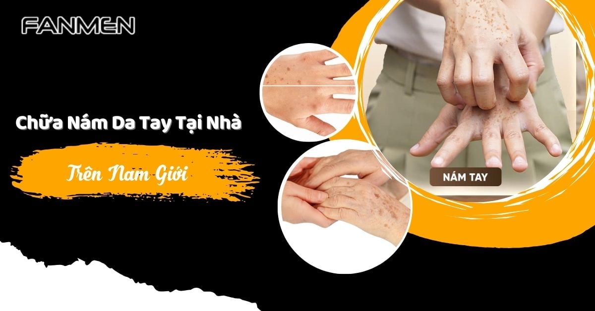 5 Cách Chữa Nám Da Tay Tại Nhà Trên Nam Giới Hiệu Quả 2025
