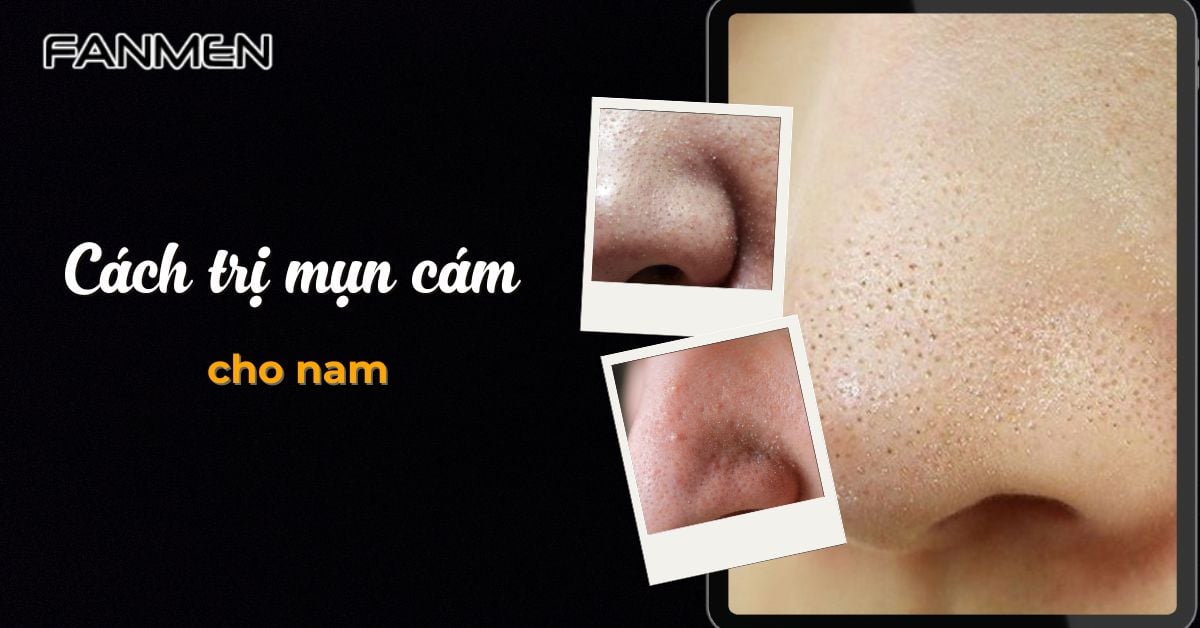 Top 9 Cách Trị Mụn Cám Cho Nam Loại Bỏ 90% Mụn Hiệu Quả