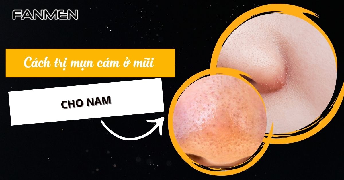 5 Cách Trị Mụn Cám Ở Mũi Cho Nam Hiệu Quả Sau 1 Lần Áp Dụng