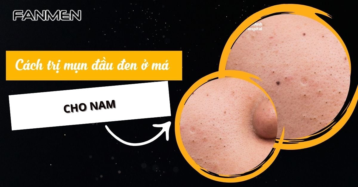 5 Cách Trị Mụn Đầu Đen Ở Má Cho Nam: Nhanh Chóng & Hiệu Quả