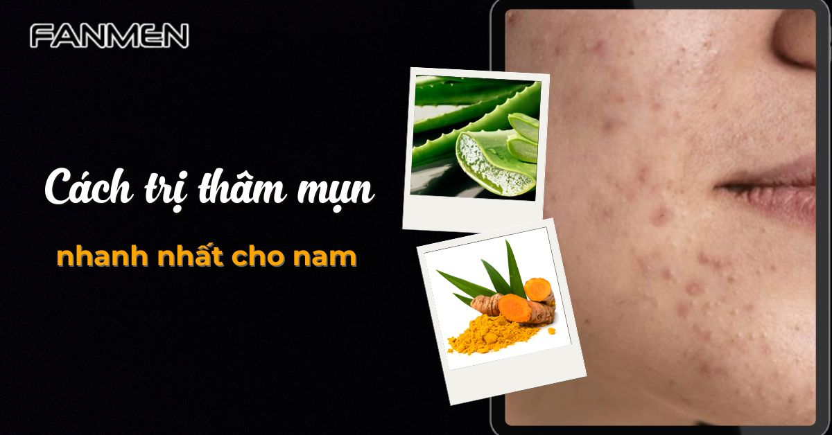 5 Cách Trị Thâm Mụn Nhanh Nhất Cho Nam Trong Vòng 24h