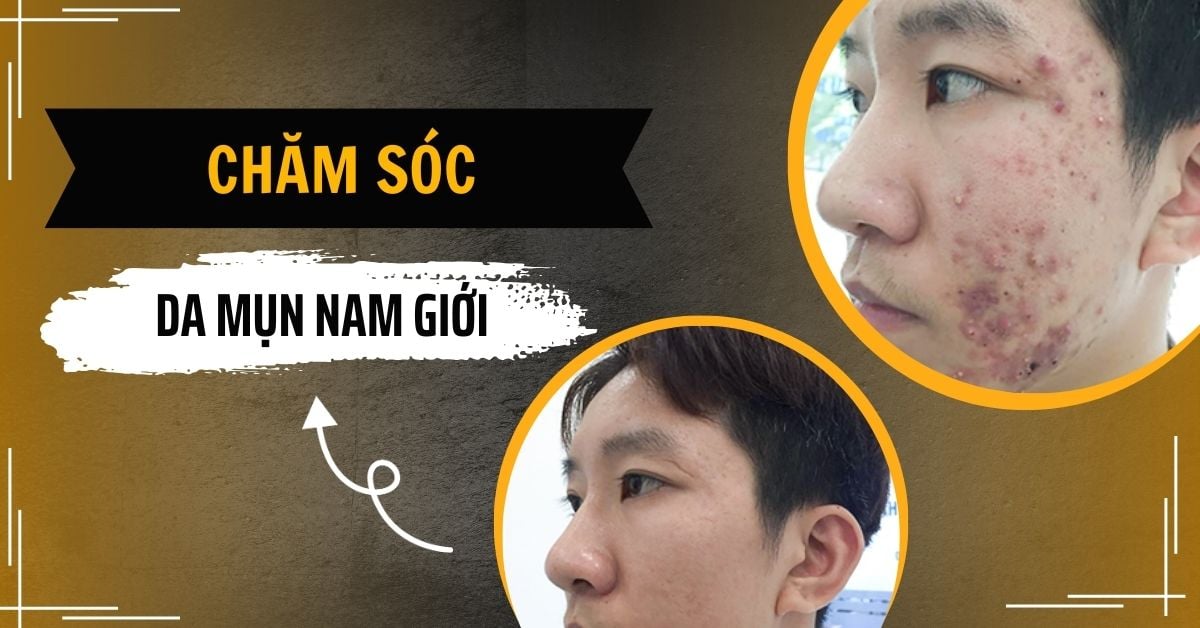 Các Bước Chăm Sóc Da Mụn Nam Giới Hiệu Quả, An Toàn Từ Chuyên Gia