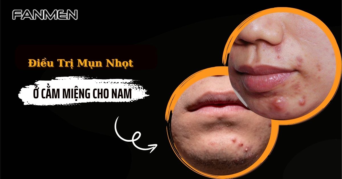 Điều Trị Mụn Nhọt Ở Cằm Miệng Cho Nam Hiệu Quả Sau 1 Tháng