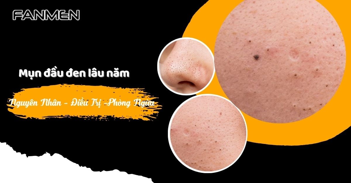 Mụn Đầu Đen Lâu Năm: Nguyên Nhân, Điều Trị Và Phòng Ngừa
