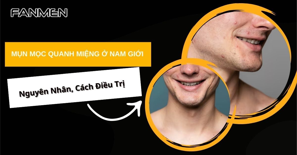 Nguyên Nhân Mụn Mọc Quanh Miệng Ở Nam Giới Và Cách Điều Trị