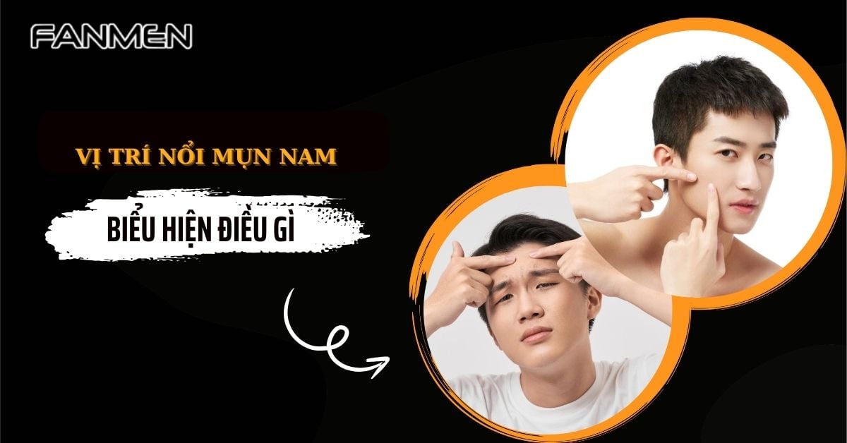 Các Vị Trí Nổi Mụn Nam Biểu Hiện Điều Gì? Cách Khắc Phục