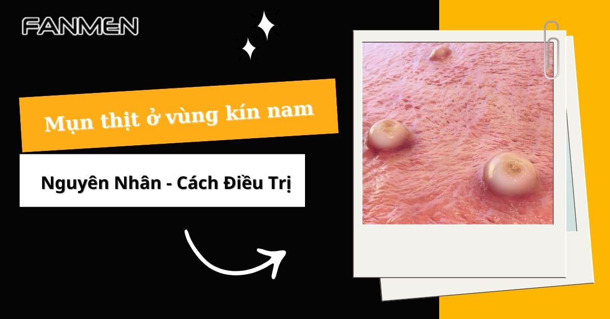 Nguyên Nhân Gây Ra Mụn Thịt Ở Vùng Kín Nam Và Cách Điều Trị