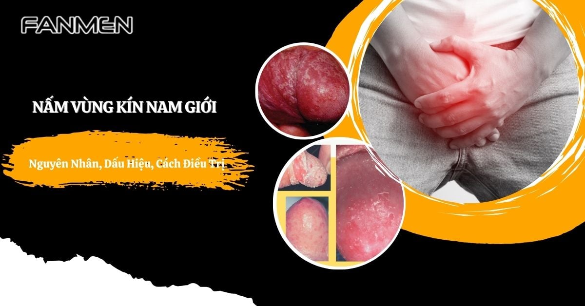 Nấm Vùng Kín Nam Giới: Nguyên Nhân, Dấu Hiệu, Cách Điều Trị