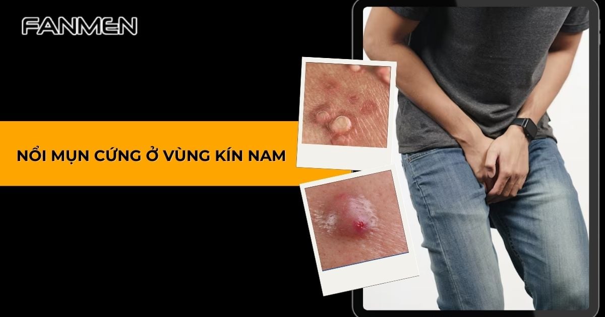 Nổi Mụn Cứng Ở Vùng Kín Nam: Nguyên Nhân, Cách Chữa Trị