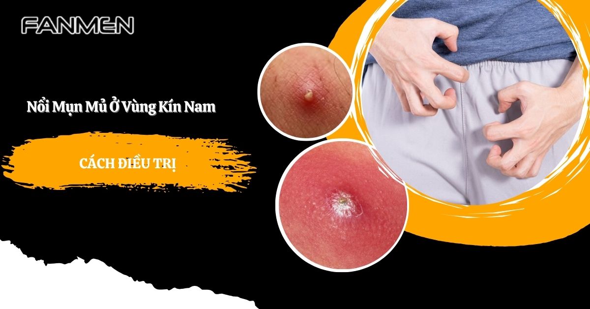 Nổi Mụn Mủ Ở Vùng Kín Nam Giới Là Bệnh Gì? Cách Điều trị
