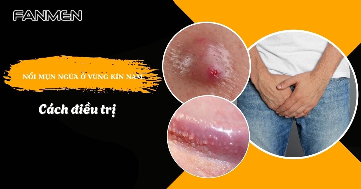 Nguyên Nhân Gây Nổi Mụn Ngứa Ở Vùng Kín Nam, Cách Điều Trị