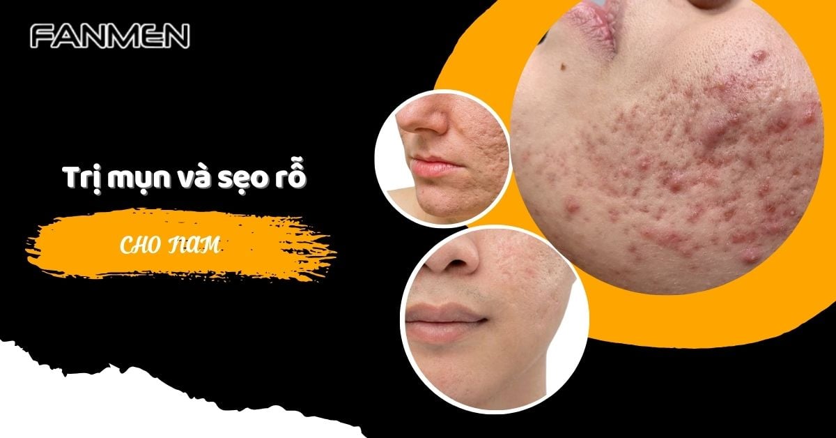 Trị Mụn Và Sẹo Rỗ Cho Nam: Giải Pháp Cho Làn Da Mịn Màng