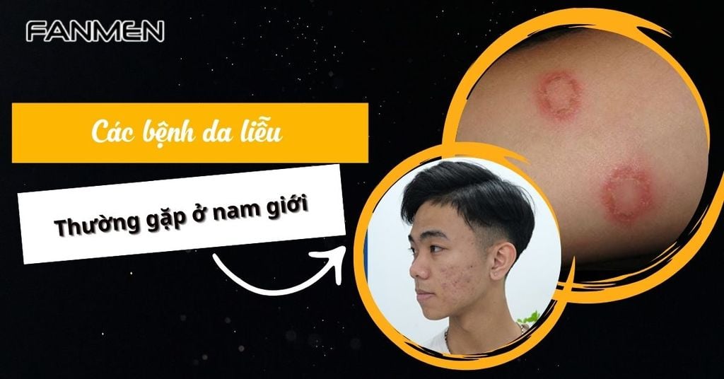 Các bệnh da liễu thường gặp ở nam giới