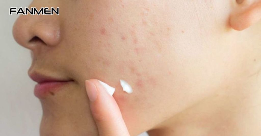 Hướng Dẫn Cách Sử Dụng Kem Trị Thâm Mụn Việt Nam