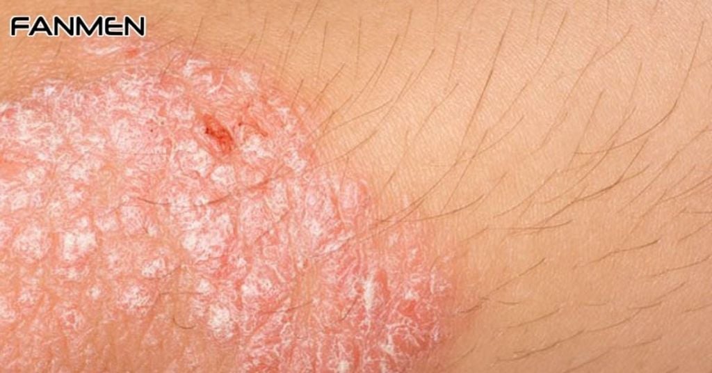 Bệnh chàm sinh dục