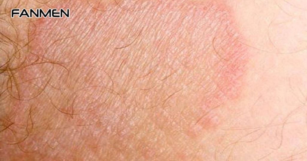 Bệnh chàm (viêm da cơ địa)