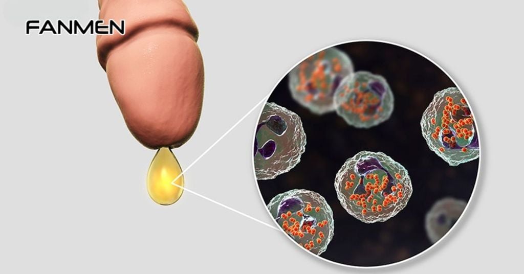 Nổi mụn mủ ở vùng kín do bệnh lậu