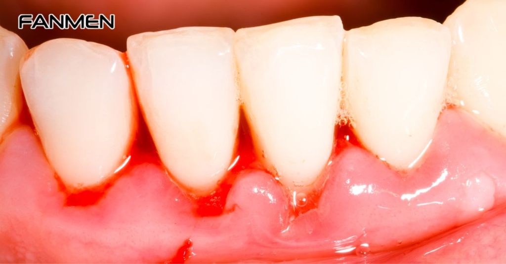 Các bệnh lý viêm nhiễm trong khoang miệng