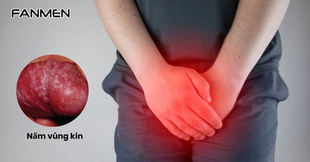 Nổi mụn ngứa ở vùng kín nam do bệnh nấm
