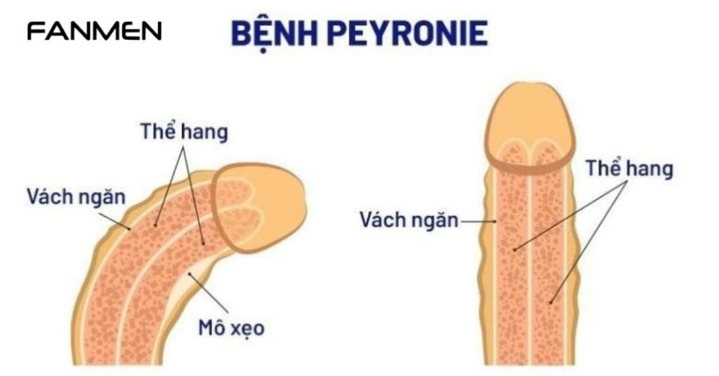 Bệnh Peyronie