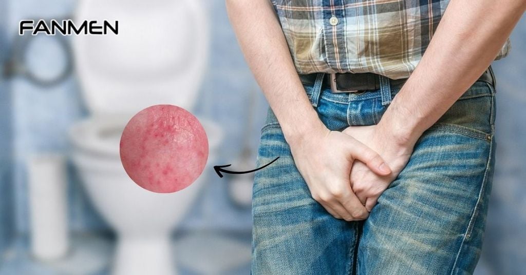 Bệnh viêm bao quy đầu