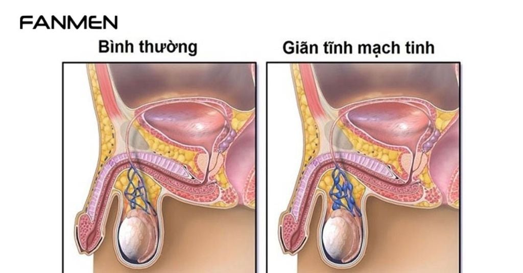 Bị giãn tĩnh mạch tinh