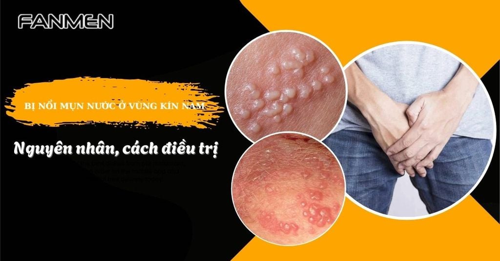 bị nổi mụn nước ở vùng kín nam