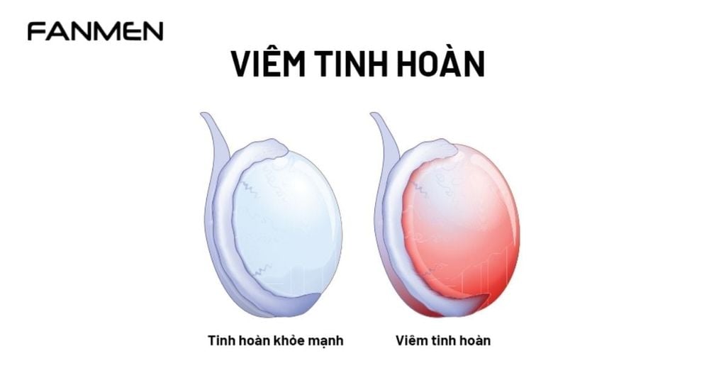 Bị viêm tinh hoàn