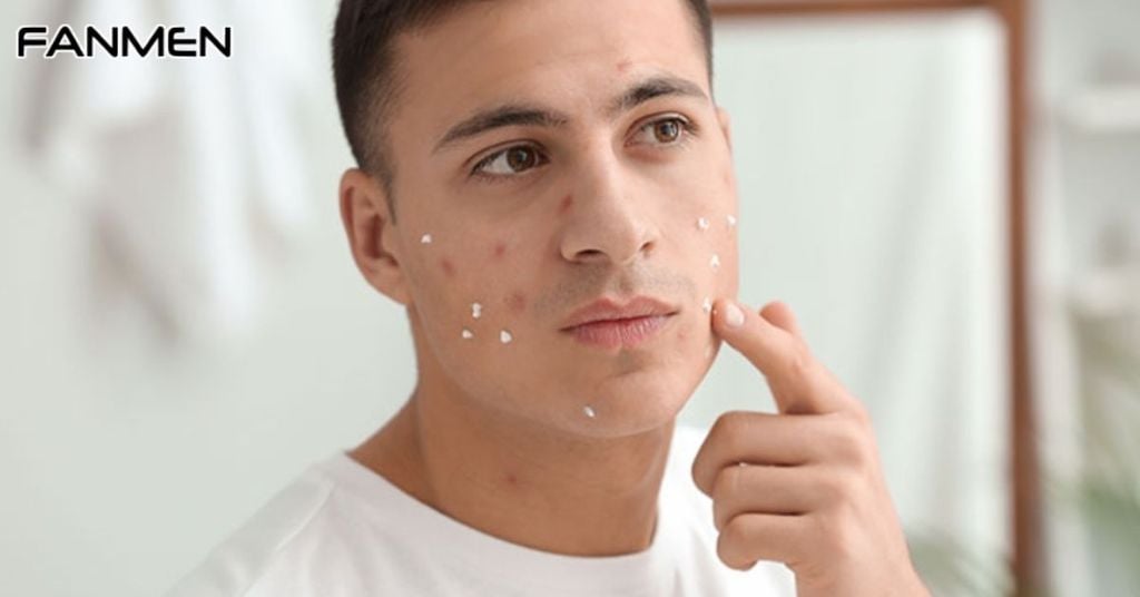 Bôi sản phẩm trị thâm mụn cho nam