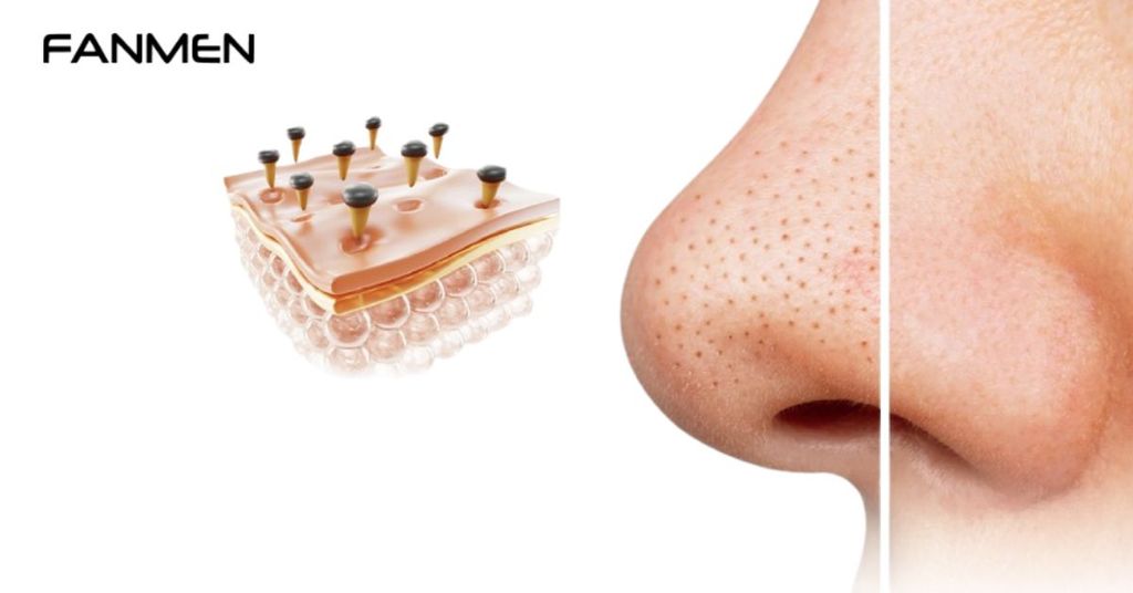 Các Phòng Ngừa Mụn Đầu Đen Hiệu Quả