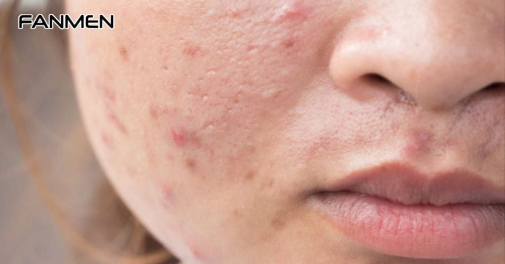 Cách trị mụn cho nam giới