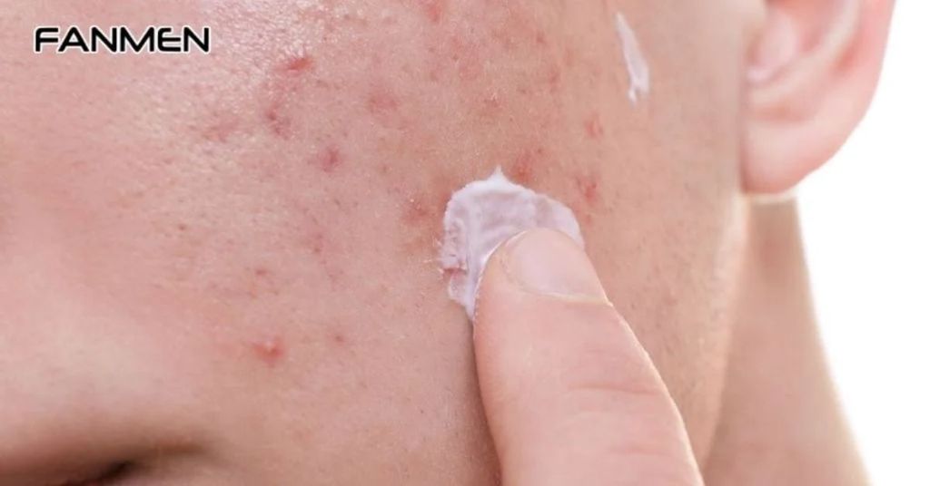 Trị Mụn Và Sẹo Rỗ Cho Nam Diễn Ra Đồng Thời Được Không?