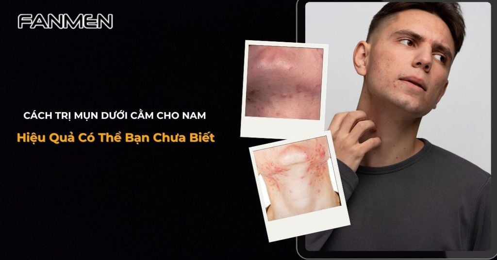 cách trị mụn dưới cằm cho nam